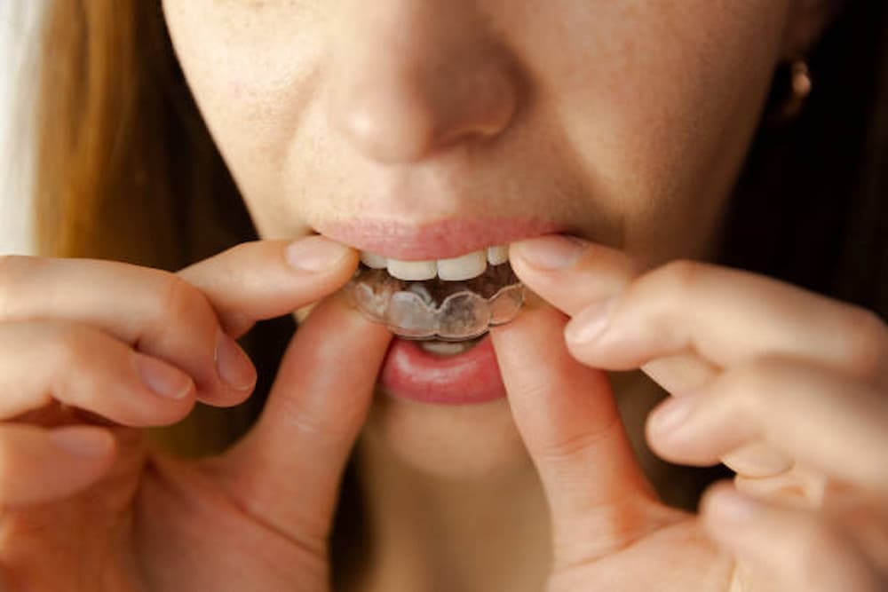 Como limpiar ferula dental