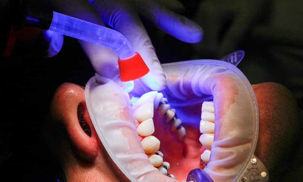 Tratamientos dentales para el dolor de muela
